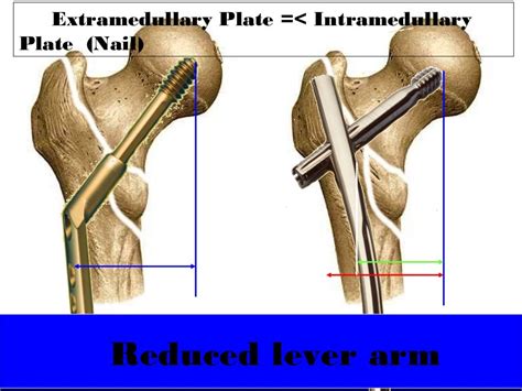 Dhs Vs Pfna For Intertrochanteric Fractures Dr Chintan N Patel