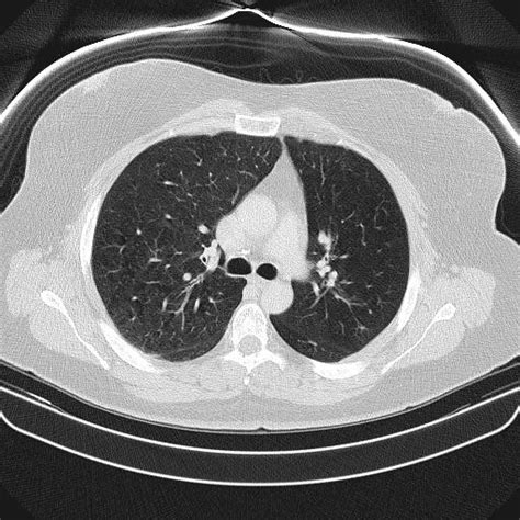 Hyperlucent Unilateral Lung Swyer James Mcleod Syndrome Eurorad