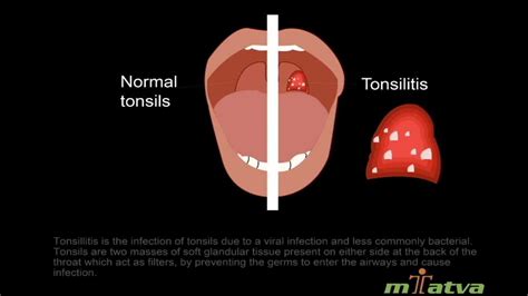Tonsillitis Youtube