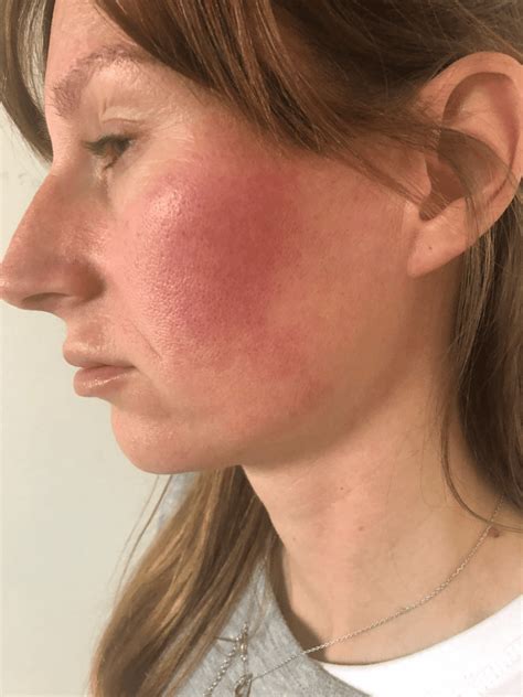 Rosaceas Story Prp Skin Therapy Results Cmg