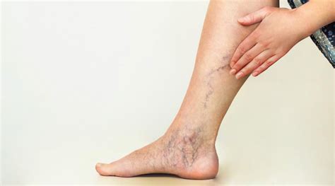 Ankle Discoloration A Sign Of Vein Disease Clement Banda Md