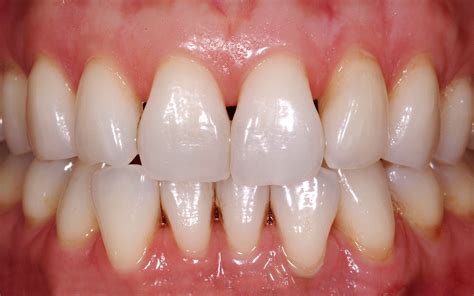 Closing The Gap In Direct Dentistry Treating Black Triangles Optident