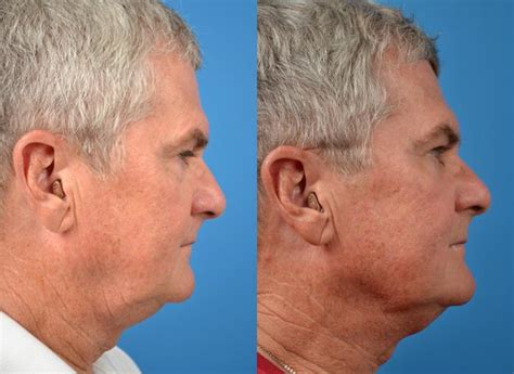 Laser Assisted Weekend Neck Lift Photos Melbourne Fl Patient 28545