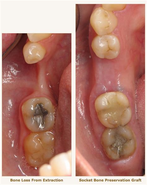 Bone Is Showing Extraction Graft Ramsey Amin Dds