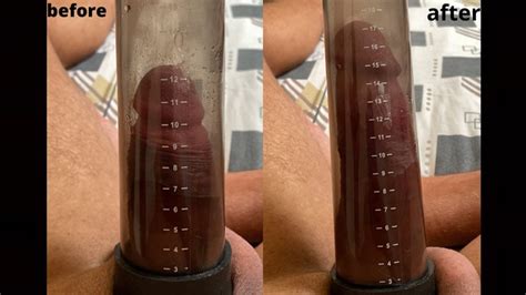 My Erect Penis Was 12 Cm Before Using The Penis Pump And After Using It