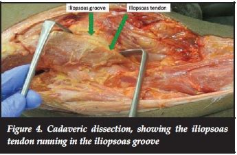 Iliopsoas Tendonitis After Hip Replacement Doctorvisit