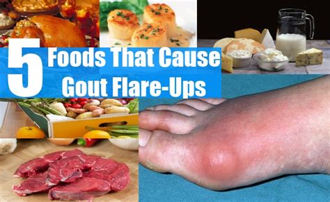 Part I What Is Gout Understanding The Disease Its Symptoms And How