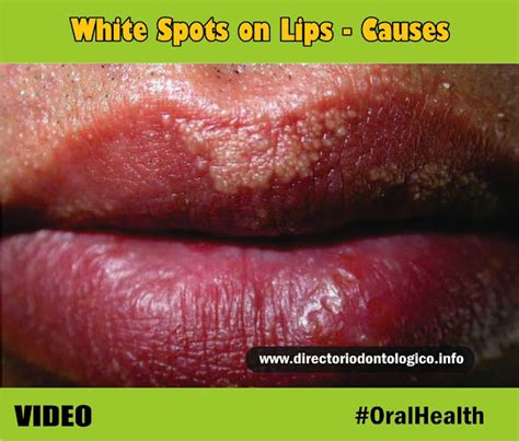White Spots On Lips Causes