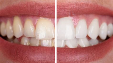 tooth discoloration causes treatment and prevention