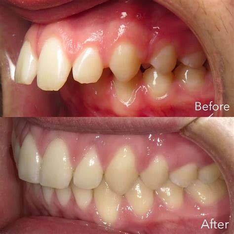 Can You Fix An Overbite Naturally 3 Easy Steps You Can Take To Fix