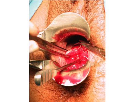 Sturmdorf sutures should be avoided. Histopathologie du col utérin - atlas numérique