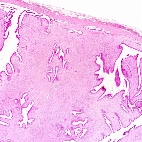 Pathology Outlines Phyllodes Tumor