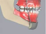 Orthodontic Chin Cup Headgear Pictures