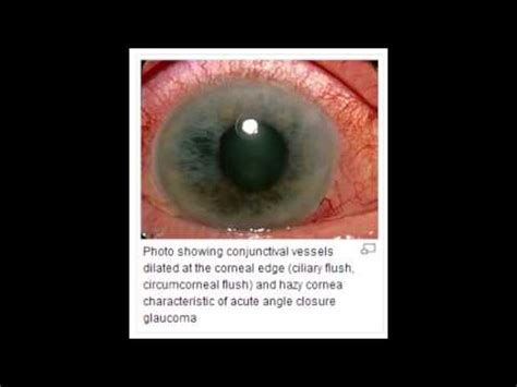 The acute form occurs when the iris completely blocks fluid drainage. Closed/Narrow Angle Glaucoma - Chronic Closure & Acute ...
