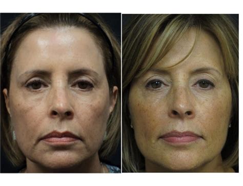 Before And After Photos Central Florida Dermatology Associates