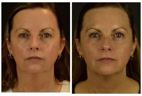 Thread Lifting The Non Surgical Face Lift