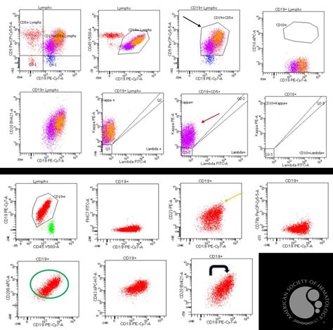 Chronic Lymphocytic Leukemia Flow Cytometry