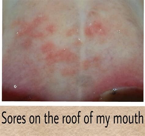 These Sores Developed On The Roof Of My Mouth Around Recovery Day 3