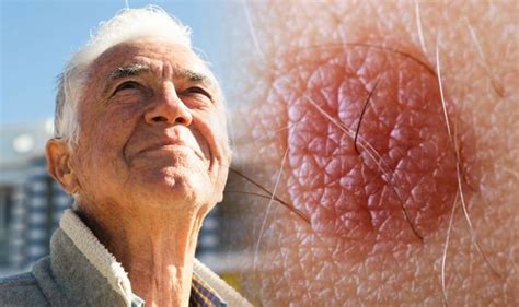 Skin Cancer Symptoms Three Easily Missed Signs Of The Deadly Condition
