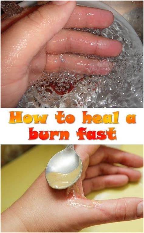 how to heal burn blisters fast home and garden reference
