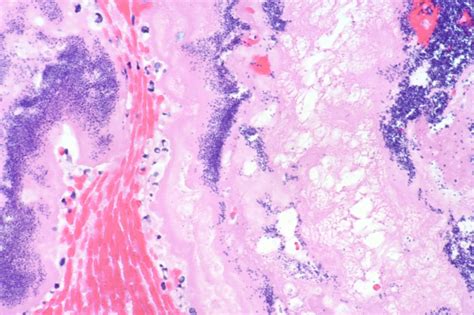 Pathology Cases — Bacterial Endocarditis Billoblog