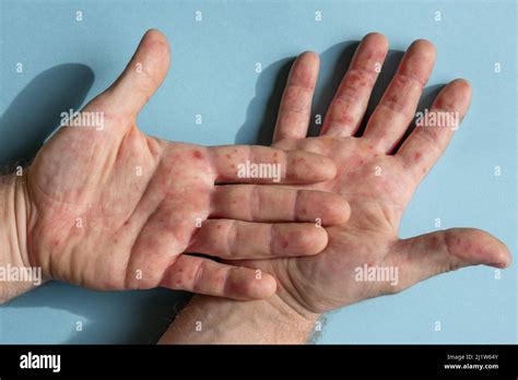 Skin Rash Eczema On Hands Hi Res Stock Photography And Images Alamy