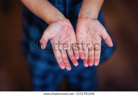 Scarlet Fever Two Hands With A Contagious Red Small Rash And Shabby Skin