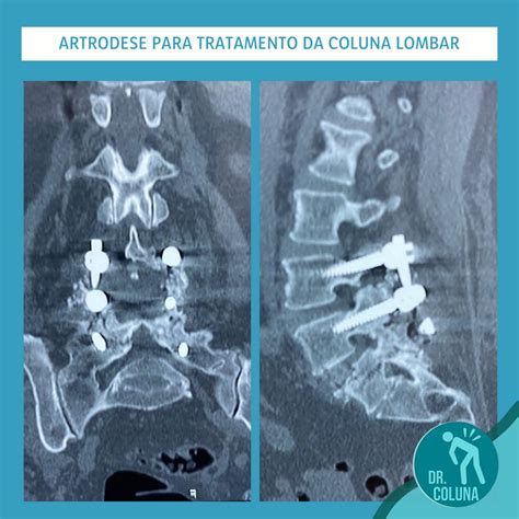 Caso ClÍnico Artrodese Para Tratamento Da Coluna Lombar