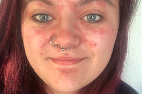 Woman Whose Psoriasis Was One Of The Worst Cases Doctors Had Ever Seen