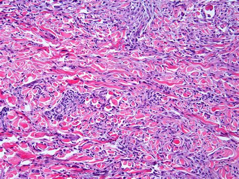 Pathology Of Granuloma Annulare Granuloma Annulare Cells And Tissues