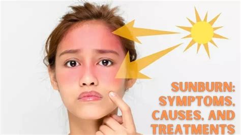 Ppt Sunburn Symptoms Causes And Treatments Powerpoint Presentation
