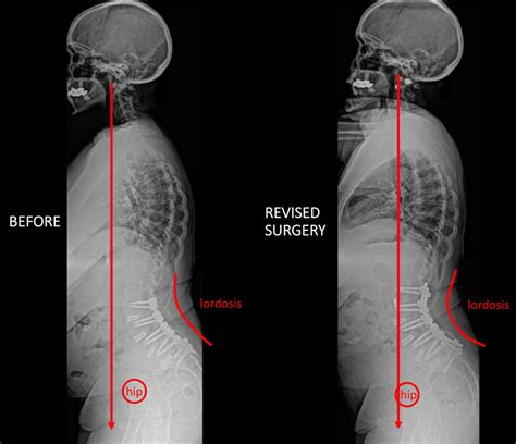 Lordosiskyphosis X Ray Results Pain Academy 56 Off