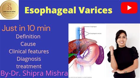 Esophageal Varices In Hindi Cause Symptoms Diagnosis Treatment Dr Hot