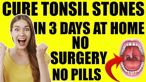 Tonsil Stones Treatment Removal At Home Get Rid Of Tonsil Stones In