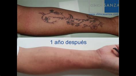Cómo Eliminar Un Tatuaje De La Piel Tattoo Con Láser Youtube