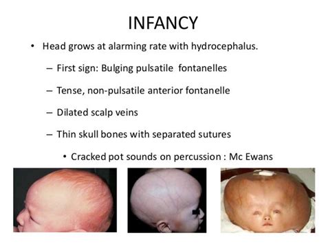 Hydrocephalus Diagnosis And Management