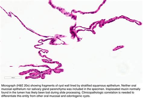 Pathology Outlines Salivary Duct Cyst