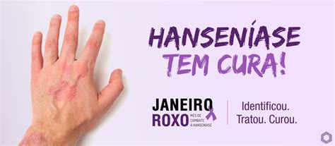 Saiba Mais Sobre Os Sinais E Sintomas Da Hanseníase