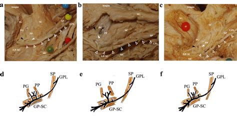 Three Nerve Branch Pattern To The Palatopharyngeal And Palatoglossus