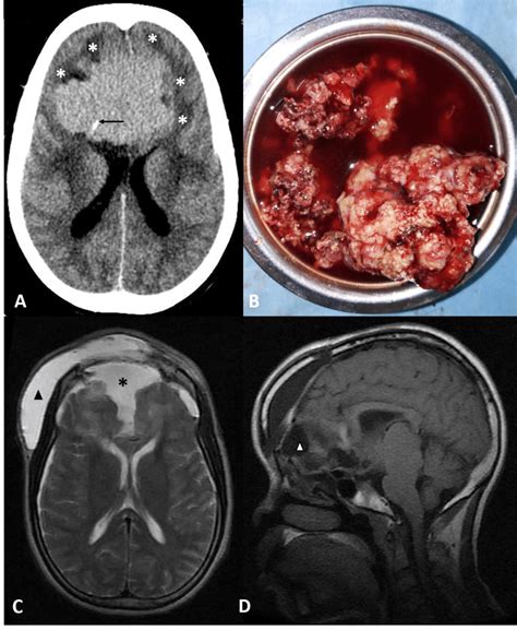 A Preoperative Axial Brain Ct Scan Slice Without Contrast Showing Download Scientific