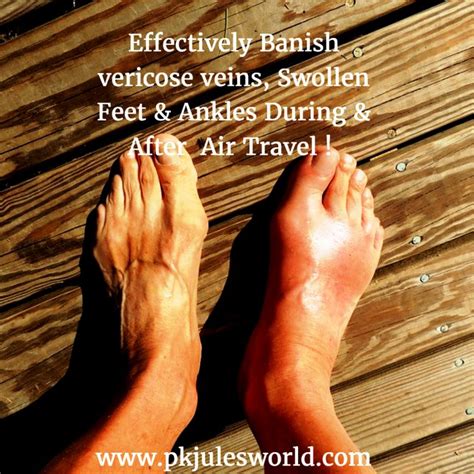 Prevent Swollen Ankles During A Flight Apply Our 14 Proven Tips