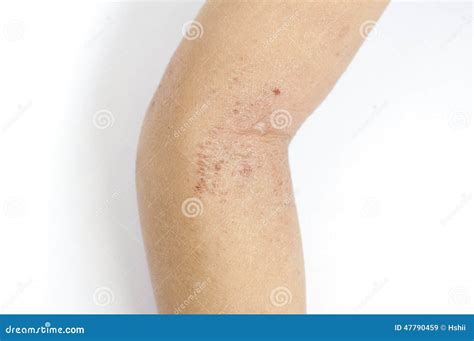 Eczema Stock Image Image Of Child Health Medical Rough 47790459