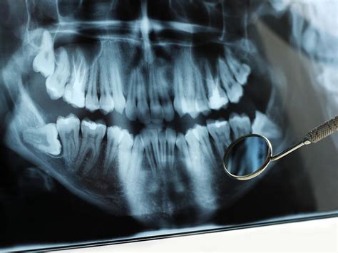 X Rays When To Take It Bello Dental Associates Cosmetic Dentists