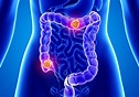Colorectal cancer mortality rates increasing in younger white adults ...