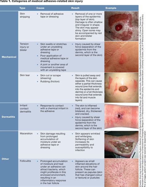 Overlooked And Underestimated Medical Adhesive Related Skin Injuries