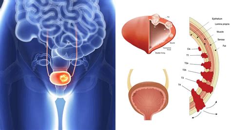 Bladder Cancer Diagram