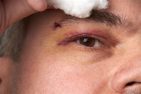 눈 근처의 타박상 혈종을 가진 남자의 얼굴의 가까운 전망 건강관리와 의술에 대한 스톡 사진 및 기타 이미지 건강관리와 의술