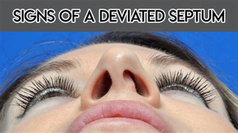 Signs Of A Deviated Septum Youtube