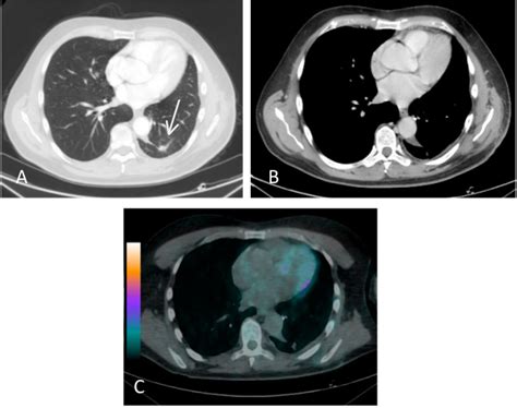 Primary Monophasic Synovial Sarcoma Of The Lung A Case Report