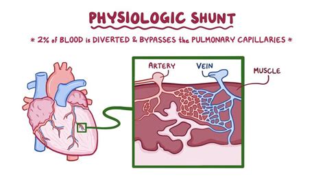O Que é Shunt Pulmonar